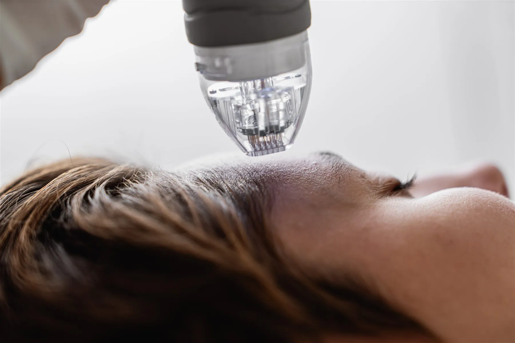 Microneedling