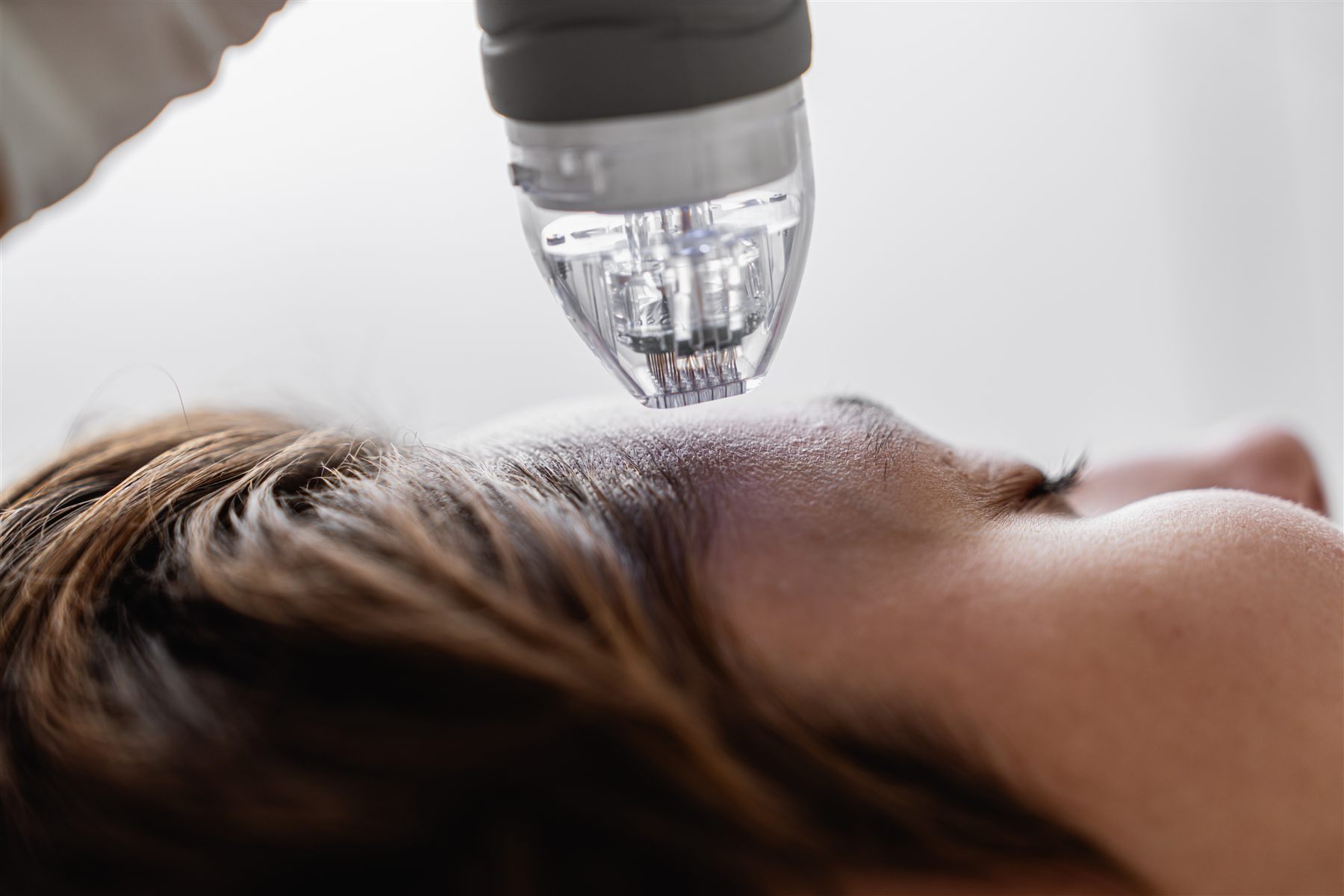 Microneedling